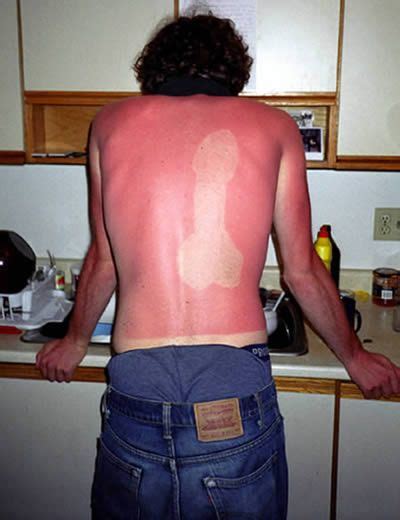 Worst Tan Disasters Bad Tanning Tan Fail Oddee Funny Sunburn Sunburn Tan Fail