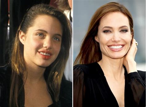 Top 10 Famous Actresses With Braces Glitzyworld