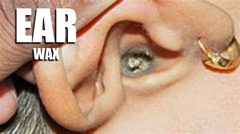 Massive Earwax Removal Biggest Ear Wax Youtube