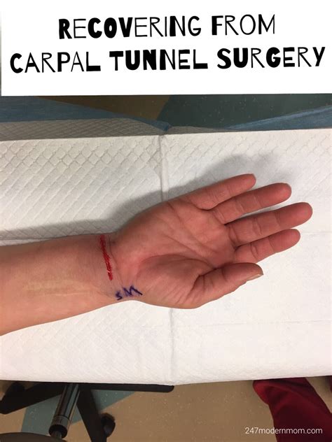 Its Been About 3 Months Since My First Carpal Tunnel Surgery I Had My Second One About 6 Weeks