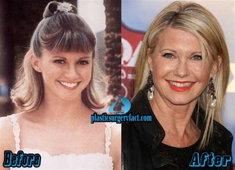 Olivia Newton John Plastic Surgery Before And After Plastic Surgery Facts