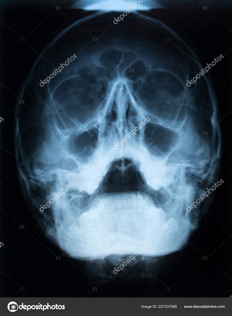 Xray Film Skull Patient Paranasal Sinus Acute Right Maxillary Sinusitis