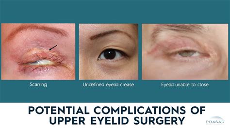 Potential Complications Of Upper Eyelid Surgery And How They Are