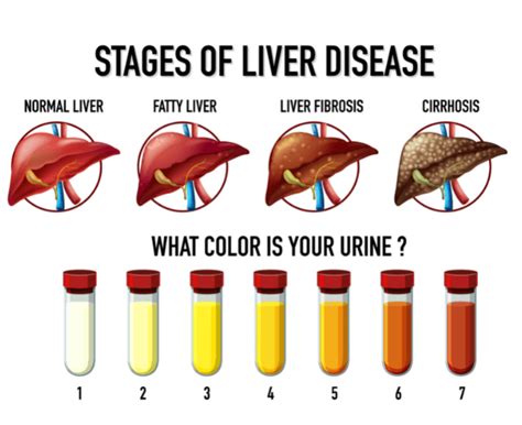 Liver Cirrhosis Causes And Preventive Measures Gastroenterologist Cpt