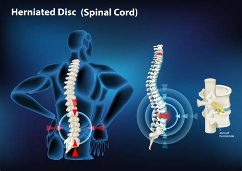 Slipped Disc Treatment Doctor