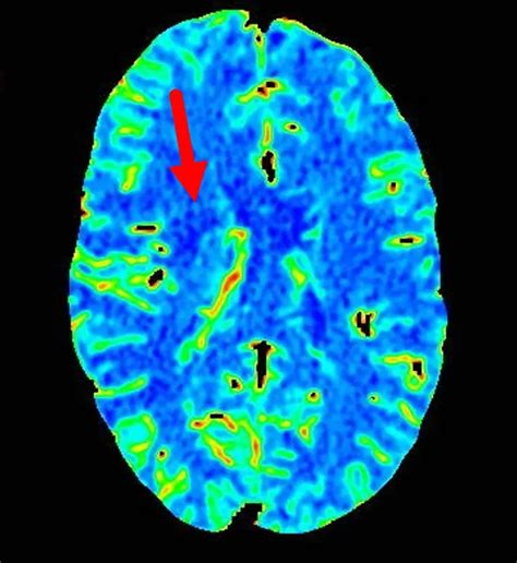 Acute Ischemic Stroke From Mca Occlusion