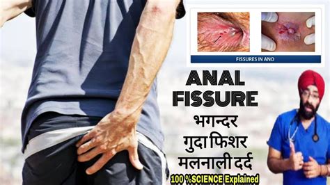 Get Rid Of Anal Fissure
