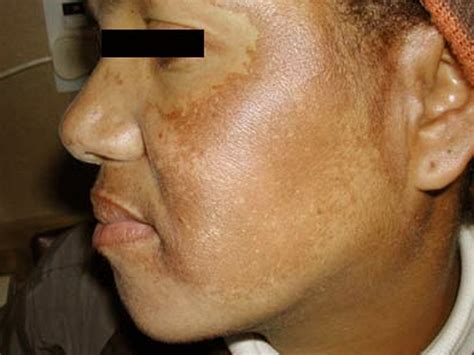 Melasma Treatment Pictures Symptoms Causes 2018 Updated