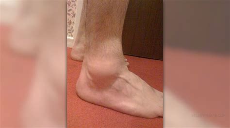 Pain In Swollen Ankle General Center
