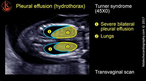 Fetal Echocardiography At 11 13 Weeks Pleural Effusion Hydrothorax