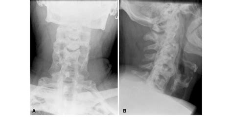 A B Antero Posterior And Lateral Radiographs Of The Cervical Spine