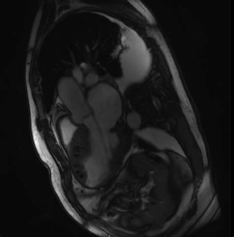 Mri Cardiac Morph And Function W Wo Contrast Greater Waterbury Imaging