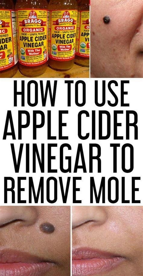 How To Use Apple Cider Vinegar For Mole Removal 7 Diy Methods