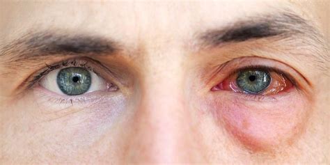 Masukkan antibiotik ke dalam mata. 5 Hal Ini Dapat Menyebabkan Cedera Mata