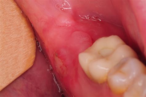 Sore Exposed Bone Following Wisdom Teeth Extractions Sore Exposed