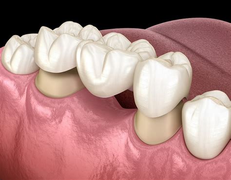 Teeth Types Bridges