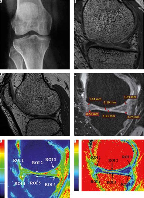 T1 And T2 Mapping Of Articular Cartilage And Menisci In Early