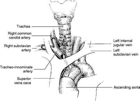 Tracheo Innominate Artery Fistula After Percutaneous Tracheostomy Three Case Reports And A