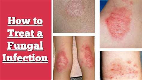 How To Treat A Fungal Infection Home Remedies For Total Relief Youtube