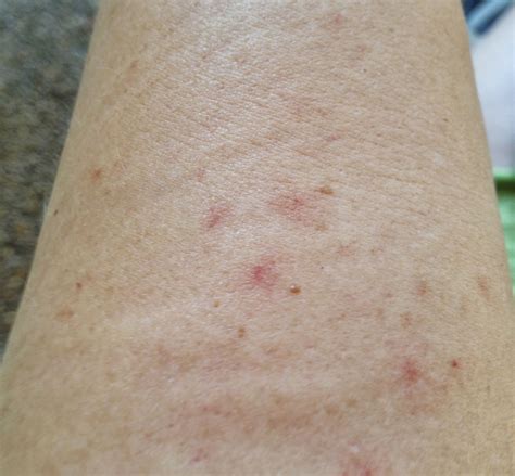 Top 103 Pictures Pictures Of Rashes On Skin Excellent