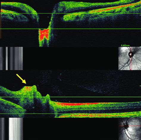 Optical Coherence Tomography Scanning Laser Ophthalmoscopy Oct Slo Of