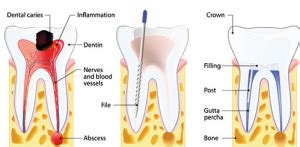 Are you preparing for root canal therapy? Root Canal treatment costs and procedure