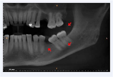 Figure 1 From Imaging Of Jaw Lesions Related To Multiple Myeloma
