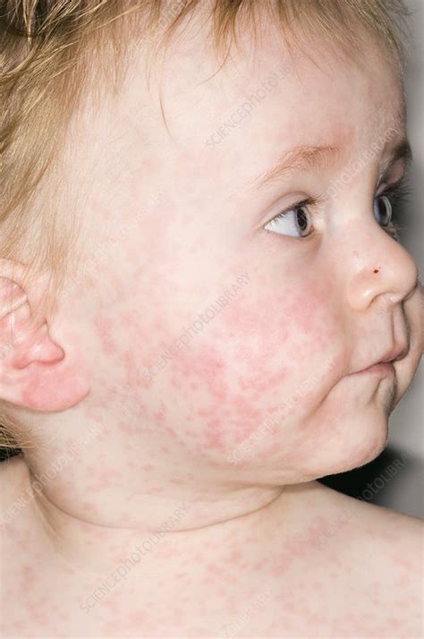 Measles Rash Stock Image M2100443 Science Photo Library