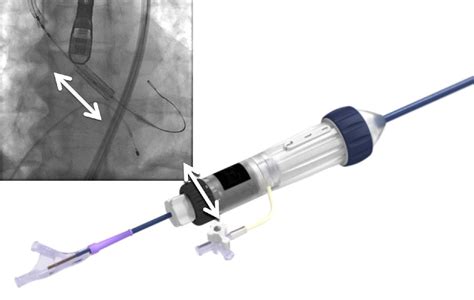 Transcatheter Aortic Valve Replacement With The Sapien 3 A New Balloon