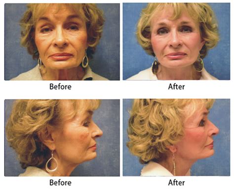 Facelift And Necklift Gallery Louisville Ky Dr Sean Maguire