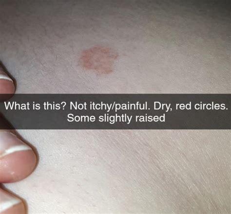 Small Bumps On Red Ink Appear 10 Days After Pico Way Laser Treatment