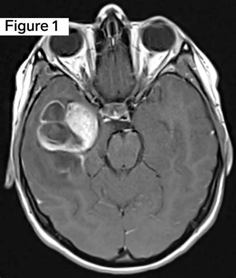 Ganglioglioma Who Grade I Neuro Notes Arkana Laboratories