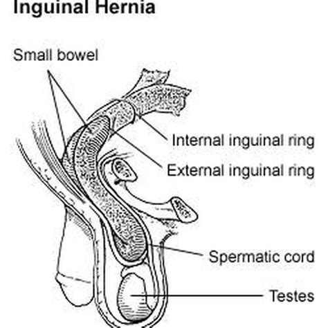 Testicular Hernia Symptoms Healthy Living