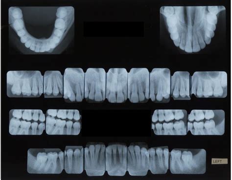 Fmx Full Mouth X Rays — Brockton Dental X Ray Lab