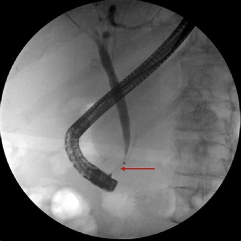 Cureus Lemmels Syndrome Secondary To Common Bile Duct Compression By
