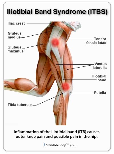 Iliotibial Band Syndrome ITBS