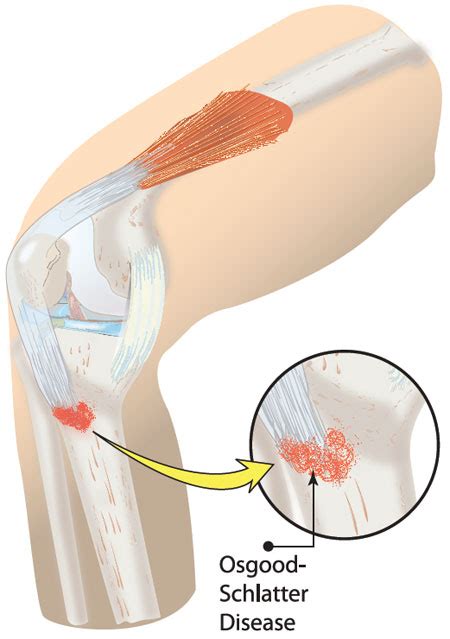 Osgood Schlatter Symptoms Causes And Treatment