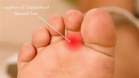 Capsulitis Of The Second Toe Symptoms Treatment And Exercises