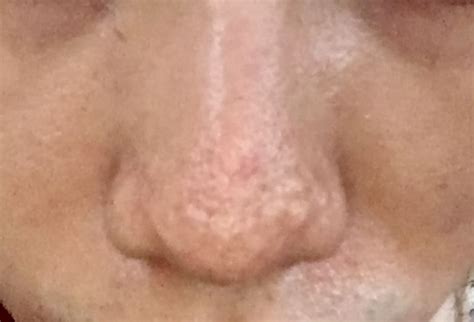 Help Hypertrophic Raised Bumpy Acne Scarring On My Nose Scar Treatments Forum