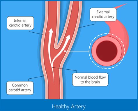 Carotid Artery Stenting Vista Vascular Clinic
