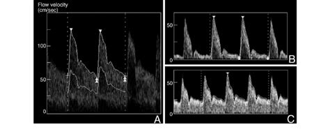A B Ultrasonograms Of The Right Superficial Temporal Artery Sta On
