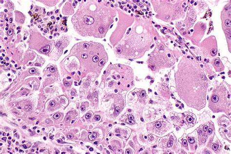 Renal Cell Carcinoma Grading Libre Pathology