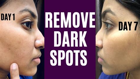 How To Remove Dark Spots From Face Naturally Black Spots Removal And