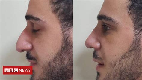 the middle eastern men having nose jobs nose job male nose job rhinoplasty nose jobs