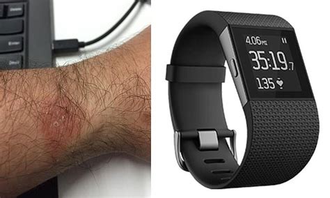 New Fitbits Are Giving Owners Rashes Firm Says Users Should Wear Them
