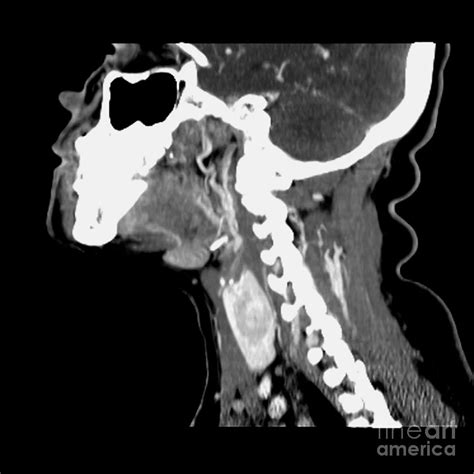 Ct Of Neck Showing Thyroid Nodule Photograph By Medical Body Scans