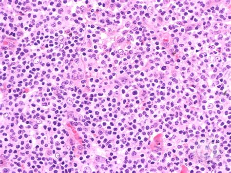 Pathology Outlines Peripheral T Cell Lymphoma Nos
