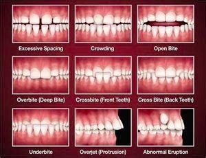 'teeth' is the plural word for tooth. Teeth Braces in Nepal | DentaLife Oral Concern Pvt. Ltd.