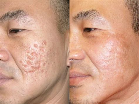 Acne Scars Boulder Co Ideal Dermatology Skin Pc