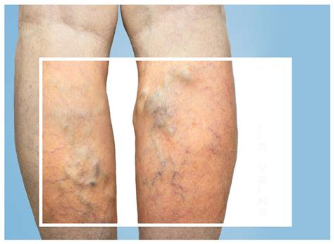 Cause And Prevention Of Common Vein Conditions The New Jersey Vein